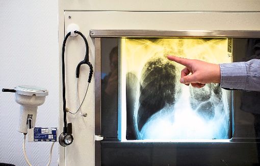 Ein Arzt zeigt, wie  eine Tuberkulose-Erkrankung auf einem Röntgenbild sichtbar wird.  Foto: Fischer