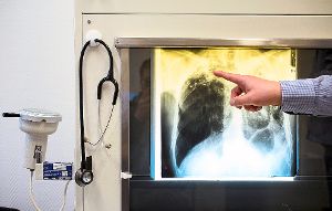 Ein Arzt zeigt, wie  eine Tuberkulose-Erkrankung auf einem Röntgenbild sichtbar wird.  Foto: Fischer